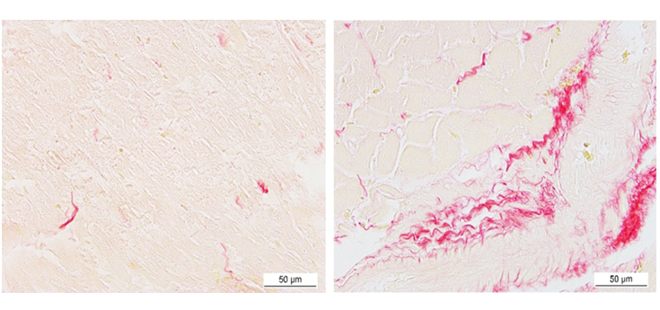 Nuevos datos sobre el desarrollo de fibrosis cardiaca en la obesidad