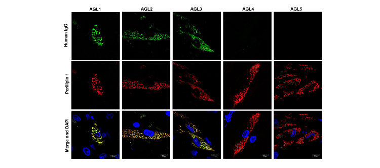 Autoanticuerpos dirigidos a tejido adiposo son causantes de lipodistrofia generalizada adquirida