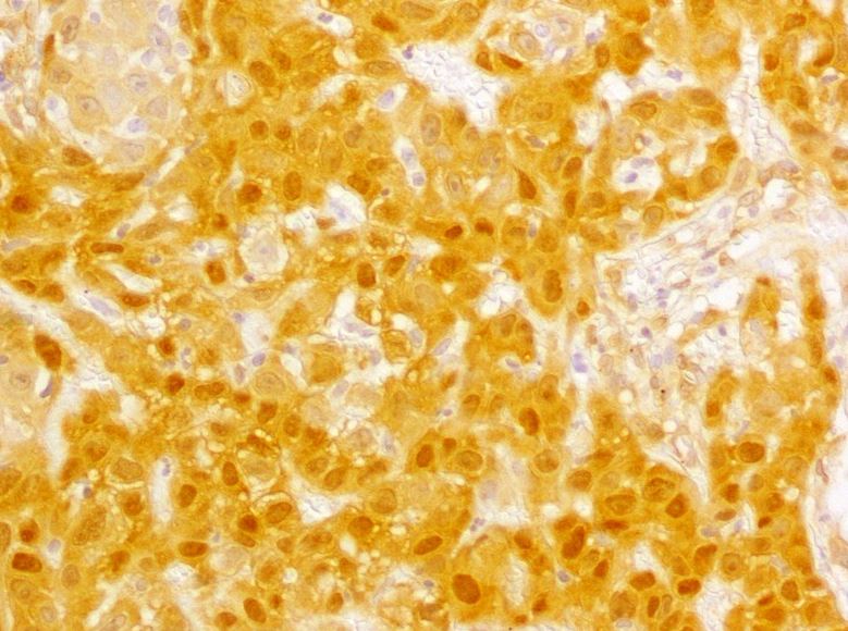 Emerge una nueva diana terapéutica para el carcinoma escamoso de cabeza y cuello