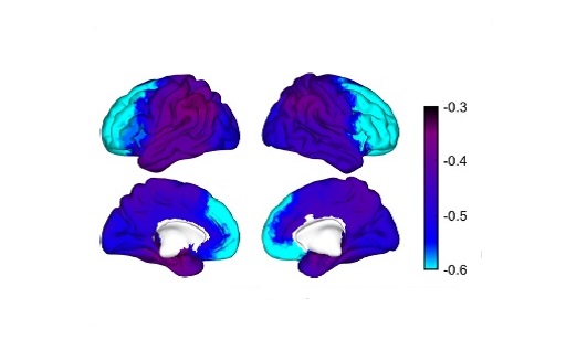 Avanzan en la detección precoz e individualizada del alzhéimer