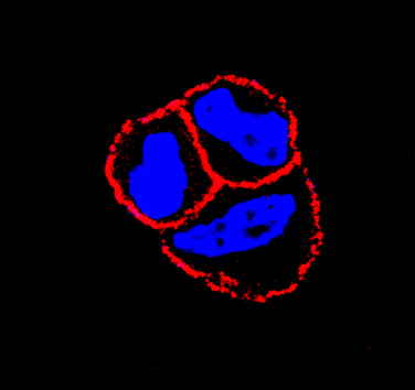 Desarrollada una nueva terapia prometedora contra uno de los cánceres de mama más agresivos