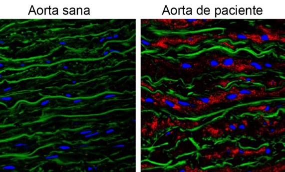 La acumulación de la proteína Versicano es responsable de los aneurismas de aorta del síndrome de Marfan