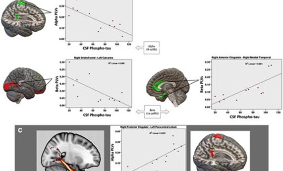 Nuevo biomarcador para la enfermedad de Alzheimer Nuevo biomarcador para la enfermedad de Alzheimer