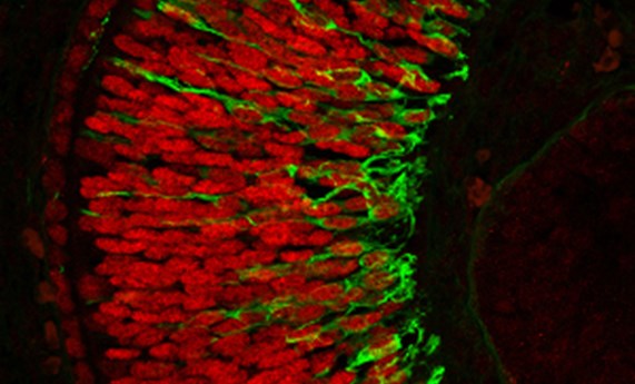 Identifican una nueva posible causa genética de microftalmia Identifican una nueva posible causa genética de microftalmia