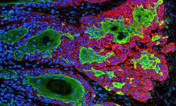 Diseñan nanopartículas que se 'despiertan' con luz ultravioleta para atacar al tumor Diseñan nanopartículas que se 'despiertan' con luz ultravioleta para atacar al tumor