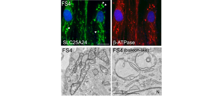 Identifican una mutación en un transportador mitocondrial que causa el síndrome de Fontaine
